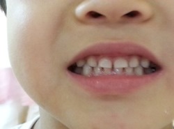 歯並びの良い子の例5　 Sくん5才