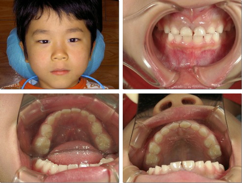 歯並びの良い子の例1
