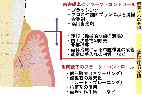 歯周病菌の減らし方