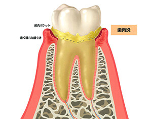 歯肉炎