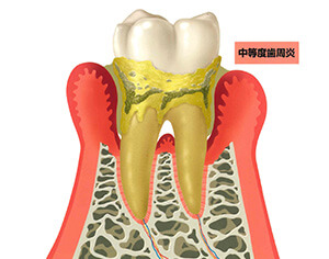 中等度歯周炎