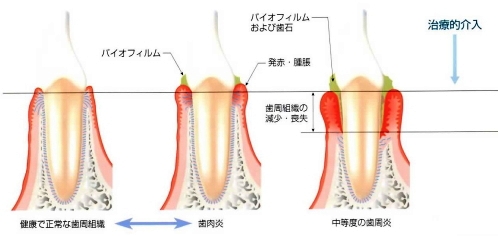 歯周病の症状