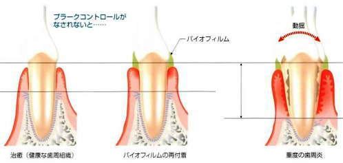 歯周病の症状