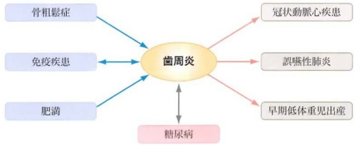 歯周病は全身に影響する