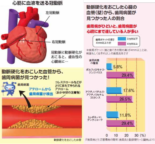 歯周病と心臓病