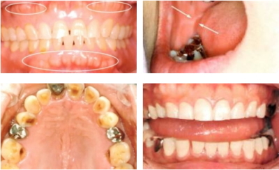 歯ぎしりによる影響