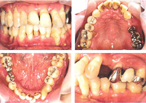 歯周病タイプ