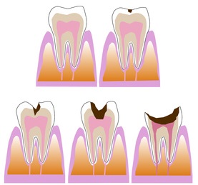 虫歯の経過