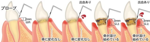 歯周ポケット