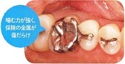 噛む力が強く、保険の金属が傷だらけの歯