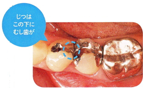 保険の金属の下にむし歯