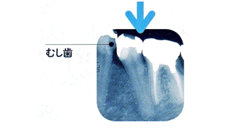 レントゲンで見てむし歯を発見