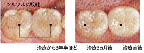 ハイブリッドセラミック