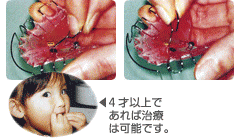 床矯正の装置の使用方法