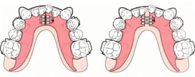 下顎の側方拡大装置