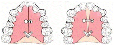 扇型拡大による上顎側方拡大装置
