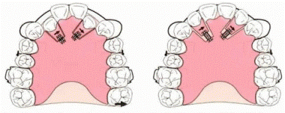 前歯の1～2歯の位置異常のケースで前歯を前方移動する