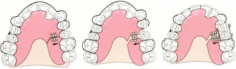 臼歯の後方移動装置