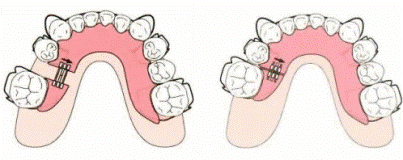 臼歯の前方移動装置
