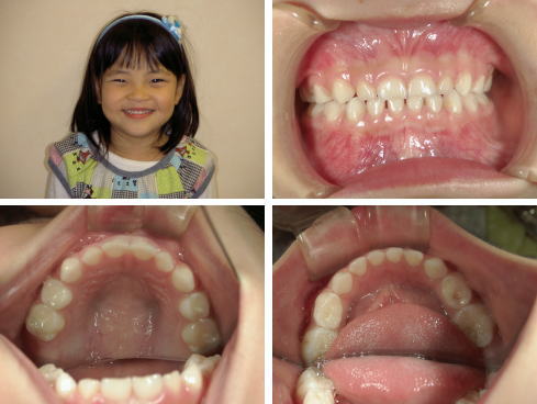歯並びの良い子の例　３