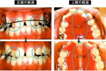 あごの拡大とワイヤーを使用した例