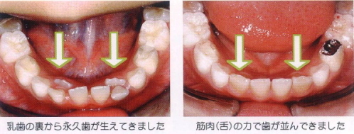 筋肉（舌）の力で歯が並んできました