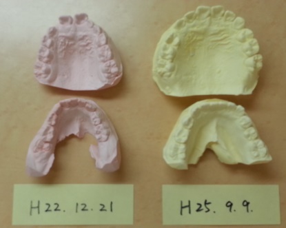 床矯正の初診時と治療開始2年9ヵ月経過した顎の模型の写真