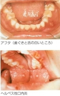 アフタ、アフタ性口内炎性口内炎