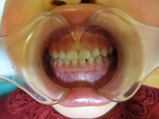 歯並びの良い子の例 ２