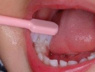 下の奥歯の裏側 奥歯の溝 