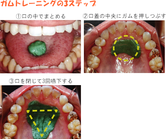 ガムトレーニング　MFT　桜新町の歯医者